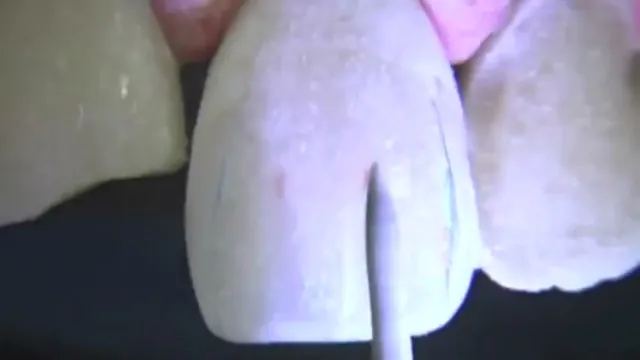 Anatomia secundária sem depressão artificial