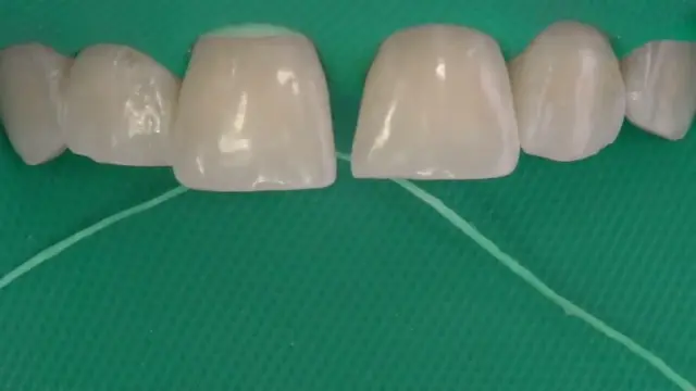 Fechar diastema sem deixar o dente largo