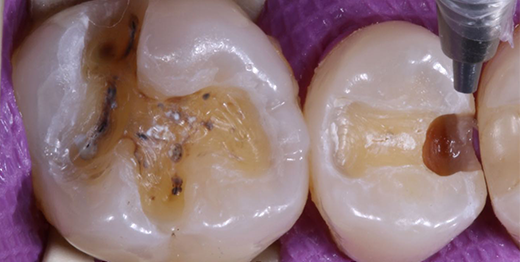 Antes: Restauração Posterior Biomimética