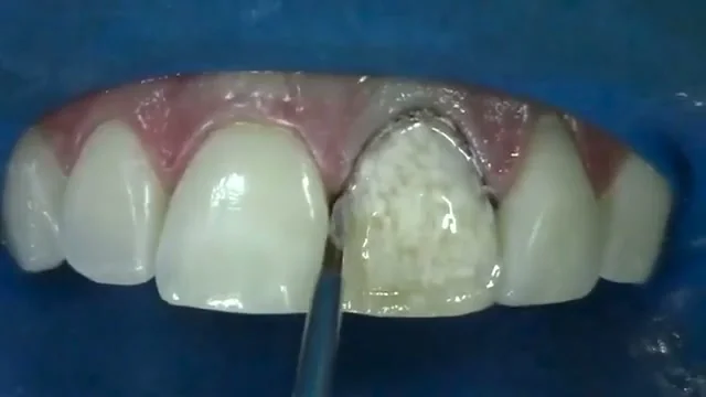 Facetar um dente que não clareava